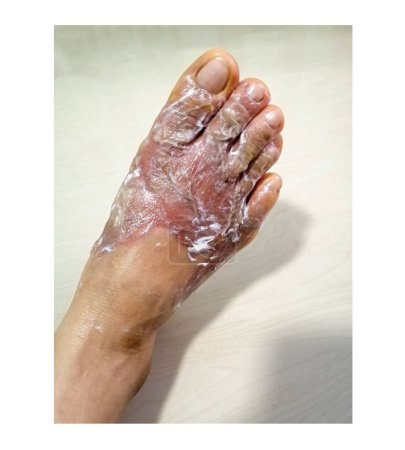 Photo for Feet with wounds due to scalds - Royalty Free Image