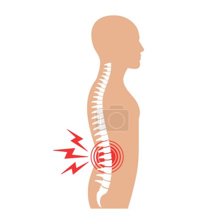 Illustration for Vector illustration of back pain. Spine ache. - Royalty Free Image