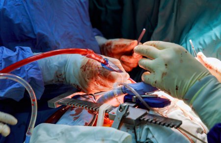 Téléchargez les photos : En raison d'un dysfonctionnement de la valvule cardiaque, une chirurgie à cœur ouvert est nécessaire pour le remplacement de la valvule dans la salle d'opération - en image libre de droit