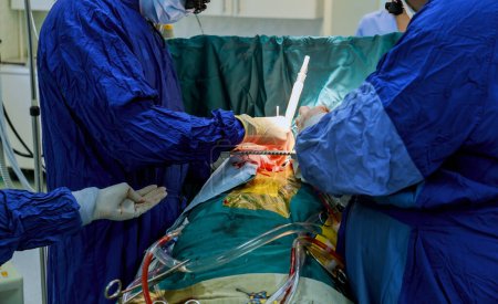 Téléchargez les photos : Pontage aortocoronarien CABG est effectué dans la salle d'opération de l'hôpital pour le traitement des maladies cardiaques parce que les maladies coronariennes. - en image libre de droit