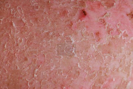 Photo for Psoriatic eczema is skin condition that falls under realm of dermatology. - Royalty Free Image