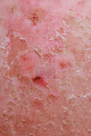 Dermatology professionals often encounter cases of psoriatic eczema in their practice.