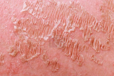Psoriatic eczema dermatology a skin problems disease