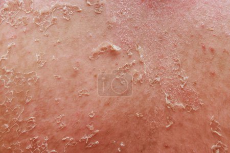 Téléchargez les photos : L'eczéma psoriasique est une maladie caractérisée par des problèmes de peau inflammation. - en image libre de droit