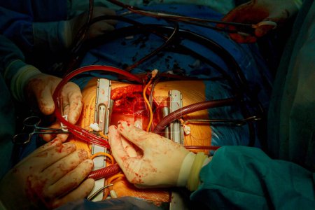 Photo for During patient surgery to remove an expandable transcatheter aortic valve at open heart - Royalty Free Image