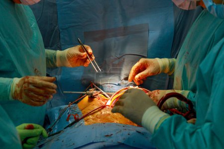 Un quirófano se utiliza para la cirugía del corazón del funcionamiento por el equipo de médicos