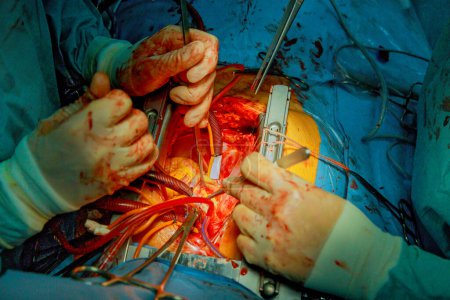 Un quirófano está ocupado por un equipo de médicos que realizan una cirugía cardíaca