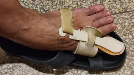 Téléchargez les photos : Orteil orthopédique, pied humain, valgus. Photo de haute qualité - en image libre de droit