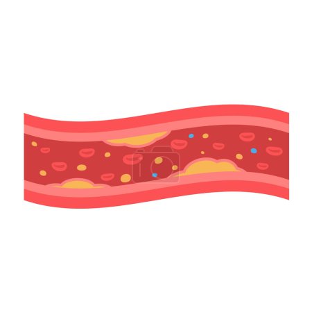 Illustration for Coronary arteries with accumulated fat in the body - Royalty Free Image