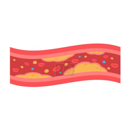 Illustration for Coronary arteries with accumulated fat in the body - Royalty Free Image