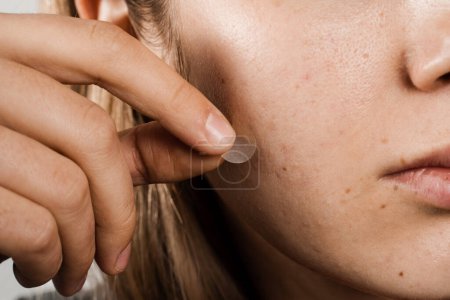 Téléchargez les photos : Fille avec bâton d'acné patch rond d'acné sur sa joue. Utilisation de patchs d'acné pour le traitement du bouton et du gros plan de la rosacée. Rajeunissement du visage nettoyage cosmétologie - en image libre de droit