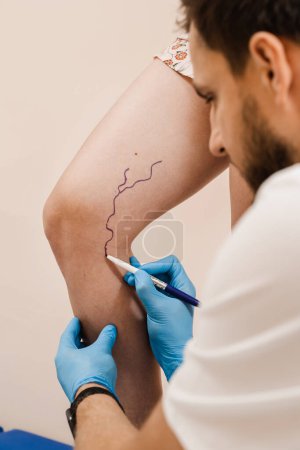 Photo for Vein markup. The phlebologist is marking legs before surgery to remove the veins. The vascular surgeon is marking leg veins - Royalty Free Image