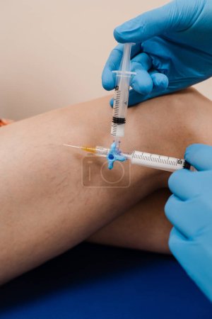 Sclerotherapy injecting into the varicose or spider vein on leg to treat blood vessel malformations. Vascular surgeon injects chemical solution into woman leg for sclerotherapy procedure