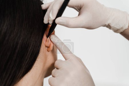 Photo for Otoplasty mark-up for surgical reshaping of pinna and ear. Otoplasty markup before ear surgery. Surgeon draw marking on ear before otoplasty cosmetic surgery - Royalty Free Image