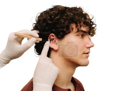 Marcado de otoplastia en la oreja. Cirujano dibujando líneas de marcado antes de Otoplastia cirujano en las orejas. Aplicación de marcado en el pabellón auricular para corregir la forma de las orejas
