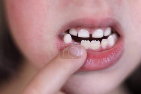 Photo for Kid with opened mouth pointing at missing front baby tooth - Royalty Free Image