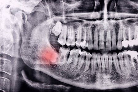Photo for Horizontal inflamed wisdom tooth on Panoramic dental tooth X-ray examination - Royalty Free Image