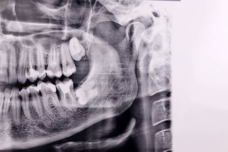 Téléchargez les photos : Dent de sagesse horizontale à l'examen radiographique dentaire panoramique - en image libre de droit