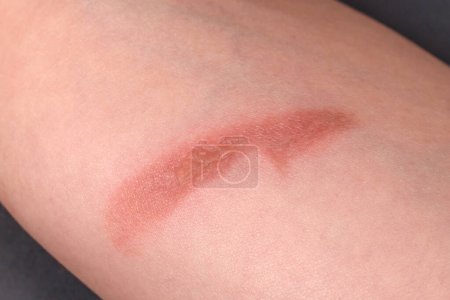 Thermal burn on human skin close up, home accident