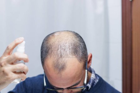Foto de Young man with alopecia looking at his head and hair in the mirror and applying a spray medicine - Imagen libre de derechos