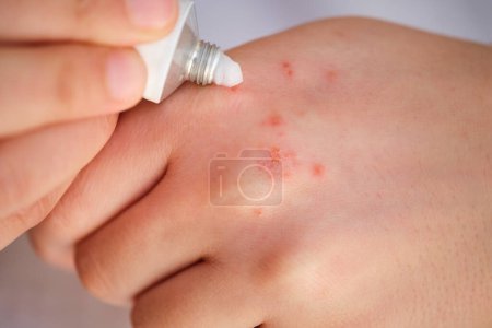 Téléchargez les photos : Femme appliquant une pommade corticostéroïde médicale blanche sur l'eczéma sur sa main. Dermatite, allergie, psoriasis concept. - en image libre de droit