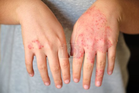 Téléchargez les photos : Femme méconnaissable avec eczéma sur les mains, concept de dermatite atopique. - en image libre de droit