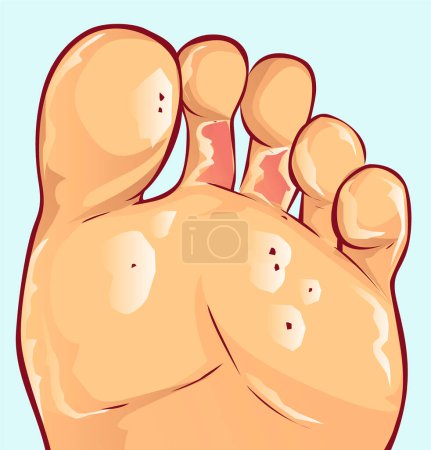 Illustration for Infections, ulcer. vector illustration - Royalty Free Image