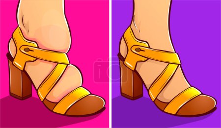 Illustration for Inconvenient shoes, swelling of the feet. Before, after. Vector illustration. - Royalty Free Image