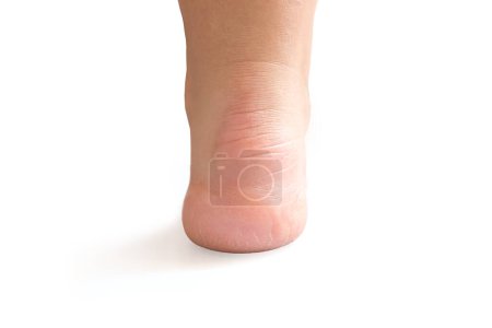 Fuß mit trockener Haut auf weißem Hintergrund, rissige Fersen. Verhornte Haut am Fuß. Fersenbehandlung. Rückansicht. Nahaufnahme