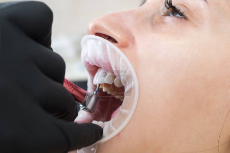 Close-up of an orthodontist wearing gloves fitting veneers on a patient's teeth during an appointment at the clinic. Restoration of teeth up close. Filing veneers. Dental care. A beautiful snow-white smile.