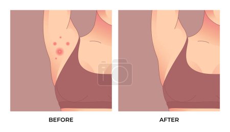 Illustration for Folliculitis Inflammatory, Acne inversa, hidradenitis suppurativa in the armpit. Acne treatment before and after. Skin care concept. - Royalty Free Image