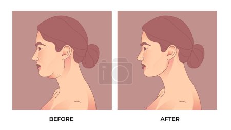 Illustration for Double Chin Liposuction. before and after Brachioplasty, liposuction or plastic surgery, woman body shape transformation, Fat To Fit. - Royalty Free Image