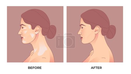 Illustration for Comparison of woman face with and without vitiligo. before and after Vitiligo skin pigmentation treatment - Royalty Free Image