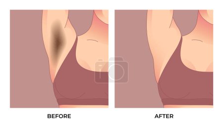 Illustration for Black underarm, before and after skin care cosmetology armpits epilation treatment. - Royalty Free Image