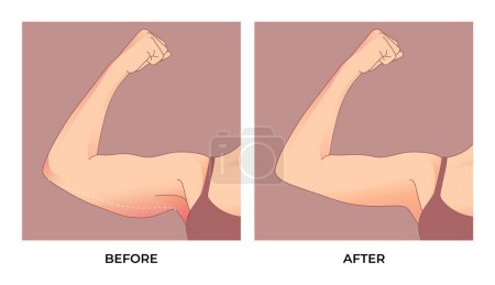 Illustration for Upper arm fat Before and after Brachioplasty, liposuction or plastic surgery, woman body shape transformation, Fat To Fit. - Royalty Free Image