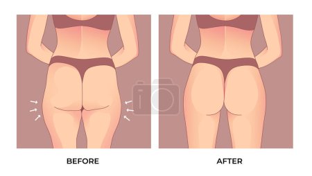 Illustration for Thigh fat. Before and after weight loss, woman body shape transformation, Fat To Fit. - Royalty Free Image