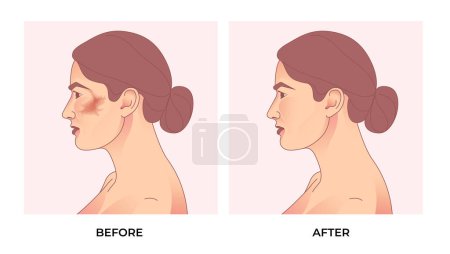 Illustration for Melasma on woman face. before and after melasma pigmentation facial treatment. - Royalty Free Image