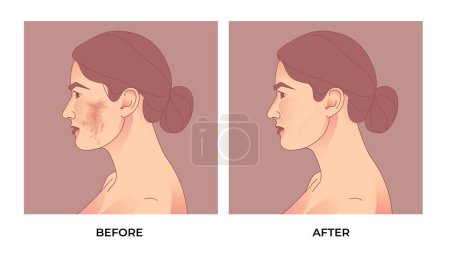 Ilustración de Melasma en la cara de mujer. antes y después del tratamiento facial de pigmentación melasma. - Imagen libre de derechos