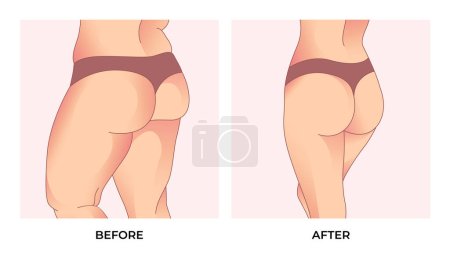 Illustration for Thigh fat. Before and after weight loss, woman body shape transformation, Fat To Fit. - Royalty Free Image
