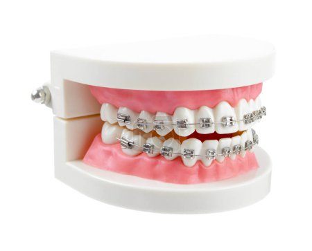 Modelo de dientes con abrazaderas dentales de alambre metálico o instrumentos dentales aislados sobre fondo blanco, Guardar ruta de recorte.