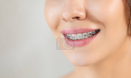 Photo for Closeup Metal Brackets on Teeth. Orthodontic Dental. Woman Healthy Smile. Female Smile with Braces. Close up of white teeth with braces. Dental care and treatment. Girl smile with Braces accessories. - Royalty Free Image