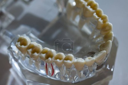 Téléchargez les photos : Modèle de dent carie, concept de soins buccodentaires. Le modèle dentaire présente des maladies dentaires courantes telles que la carie, la dent de sagesse. Santé buccodentaire. Espace de copie. Problèmes de santé dentaire. Dof peu profond - en image libre de droit