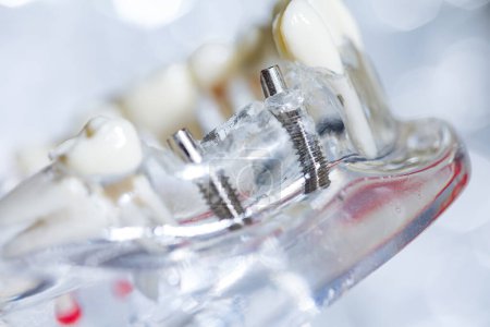Téléchargez les photos : Modèle de prothèse dentaire en titane pour implants dentaires. Dof peu profond - en image libre de droit