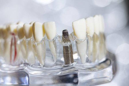 Foto de Implante dental modelo dentista protésico de titanio. Dof poco profundo - Imagen libre de derechos