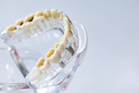 Téléchargez les photos : Modèle de dent carie, concept de soins buccodentaires. Le modèle dentaire présente des maladies dentaires courantes telles que la carie, la dent de sagesse. Santé buccodentaire. Espace de copie. Problèmes de santé dentaire - en image libre de droit