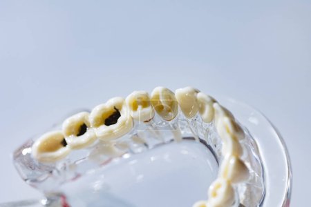 Téléchargez les photos : Modèle de dent carie, concept de soins buccodentaires. Le modèle dentaire présente des maladies dentaires courantes telles que la carie, la dent de sagesse. Santé buccodentaire. Espace de copie. Problèmes de santé dentaire - en image libre de droit