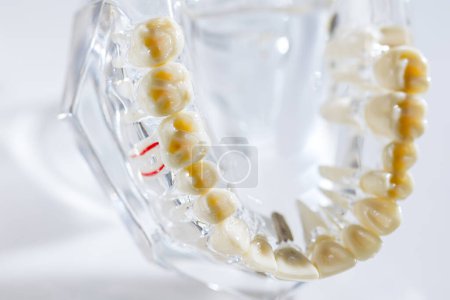Foto de Implante dental, raíces dentales artificiales en la mandíbula, conducto radicular del tratamiento dental, enfermedad de las encías, modelo de dientes para dentista que estudia odontología. - Imagen libre de derechos