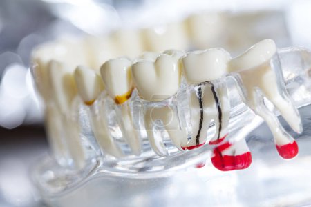 Foto de Implante dental, raíces dentales artificiales en la mandíbula, conducto radicular del tratamiento dental, enfermedad de las encías, modelo de dientes para dentista que estudia odontología. - Imagen libre de derechos