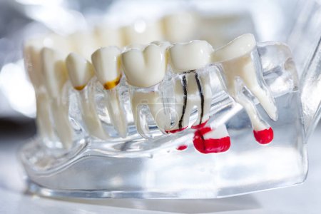 Téléchargez les photos : Implants dentaires, racines dentaires artificielles dans la mâchoire, canal radiculaire du traitement dentaire, maladie des gencives, modèle dentaire pour dentiste étudiant la dentisterie. - en image libre de droit