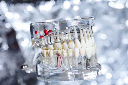Photo for Dental tooth implant titanium prosthetic dentists model. Shallow dof - Royalty Free Image